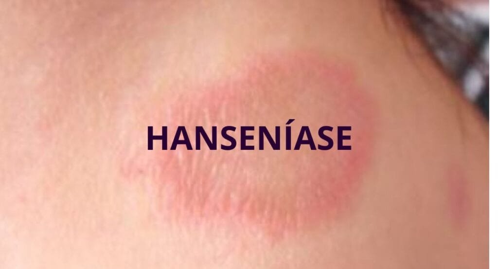 mancha de hanseniase