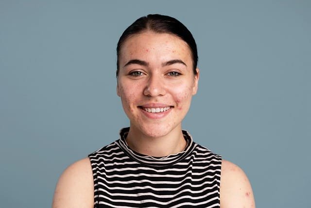 espinha interna em mulher sorrindo